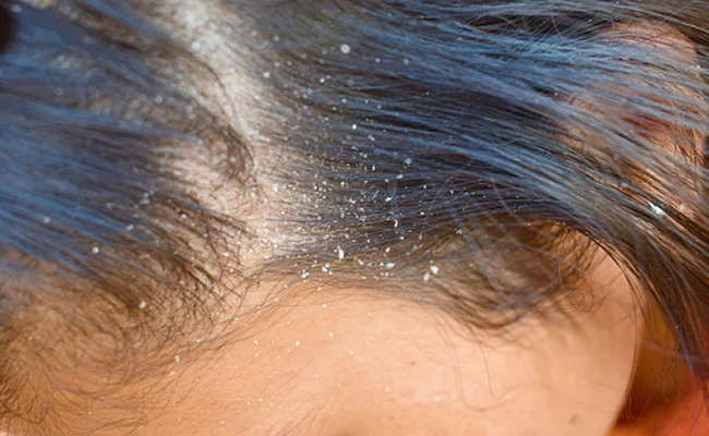 If you are troubled by dandruff and itching in the head, then try this method today, you will get immediate relief.