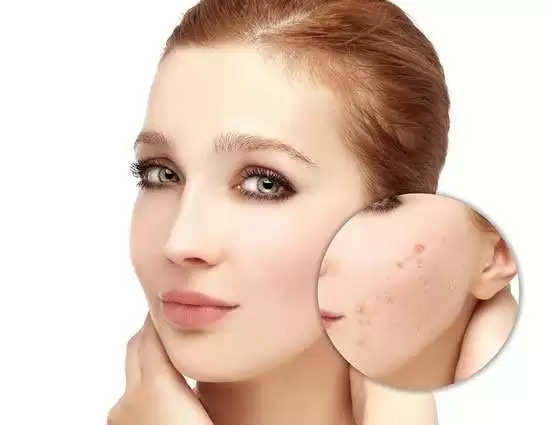 If acne scars have taken away the beauty of your face, then know the right way to clean them.